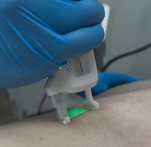 Medical spa Laser hair removal