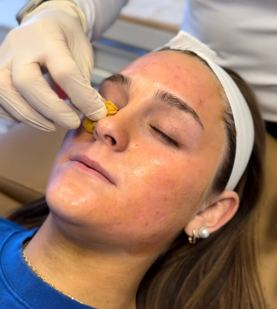 Chemical Peels being applied