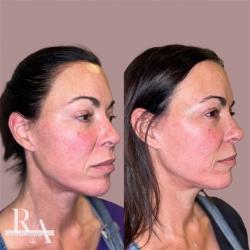 XERF before and after RF skin tightening