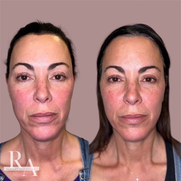 XERF before and after RF skin tightening treatment at radiant aesthetics hudson oaks granbury