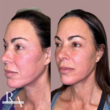 XERF before and after RF skin tightening Weatherford hudson oaks granbury