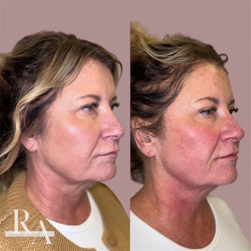 XERF before and after RF skin tightening Radiant Aesthetics treatment