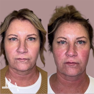 XERF before and after RF skin tightening Radiant Aesthetics treatment