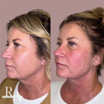 XERF before and after RF skin tightening Radiant Aesthetics treatment