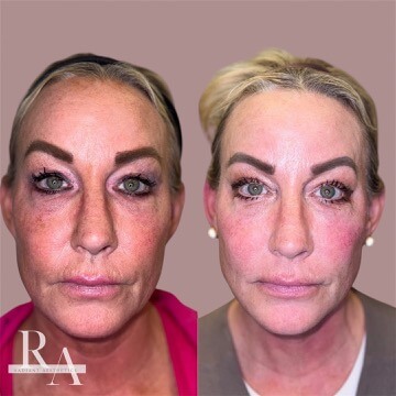 XERF before and after RF skin tightening Radiant Aesthetics treatment