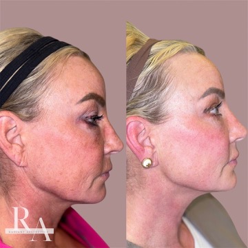 XERF before and after RF skin tightening Radiant Aesthetics treatment