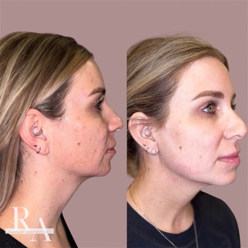 XERF before and after RF skin tightening