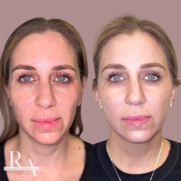 XERF before and after RF skin tightening