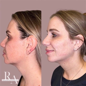 XERF before and after RF skin tightening Kim Kardashian new favorite treatment