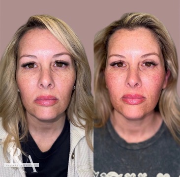Before XERF neck skin tightening — patient with sagging neck skin and early crepey texture before XERF radiofrequency treatment