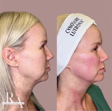 After XERF skin tightening treatment — patient displaying visibly firmer facial skin, improved jawline definition, and smoother skin texture following XERF facial treatment