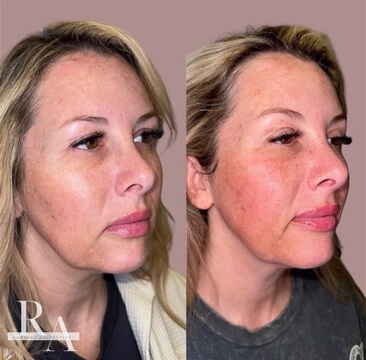After XERF neck skin tightening — patient showing noticeably tighter neck skin, reduced laxity, and improved neck contour after XERF treatment