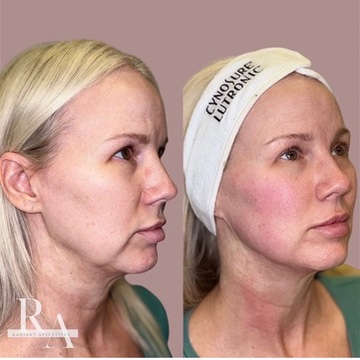Before XERF skin tightening treatment — patient showing loose facial skin, fine lines, and reduced facial contour definition prior to XERF therapy
