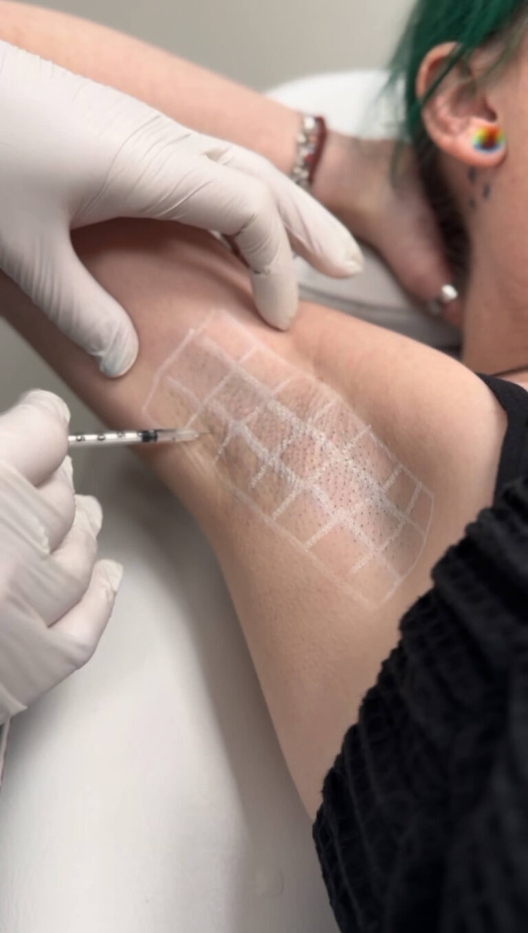Hyperhydrosis treatment at Radiant Aesthetics