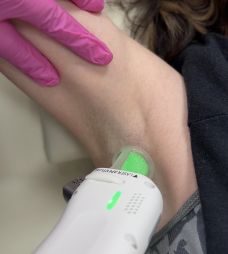 Laser hair removal after Hyperhydrosis treatment for excessive sweating