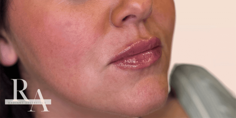 Before and after photo of lips done at Radiant Aesthetics