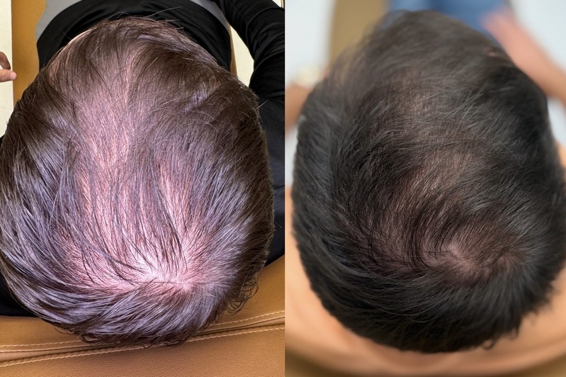 Before and after photo of hair restoration results 3 months after using PDGF