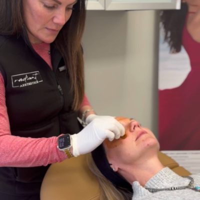 Chemical peels
